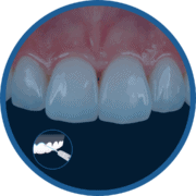 Laser Litetouch Cirúrgico na Odontologia Estética