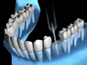 Implantes dentários Fortaleza