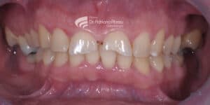 tratamento para bruxismo em fortaleza