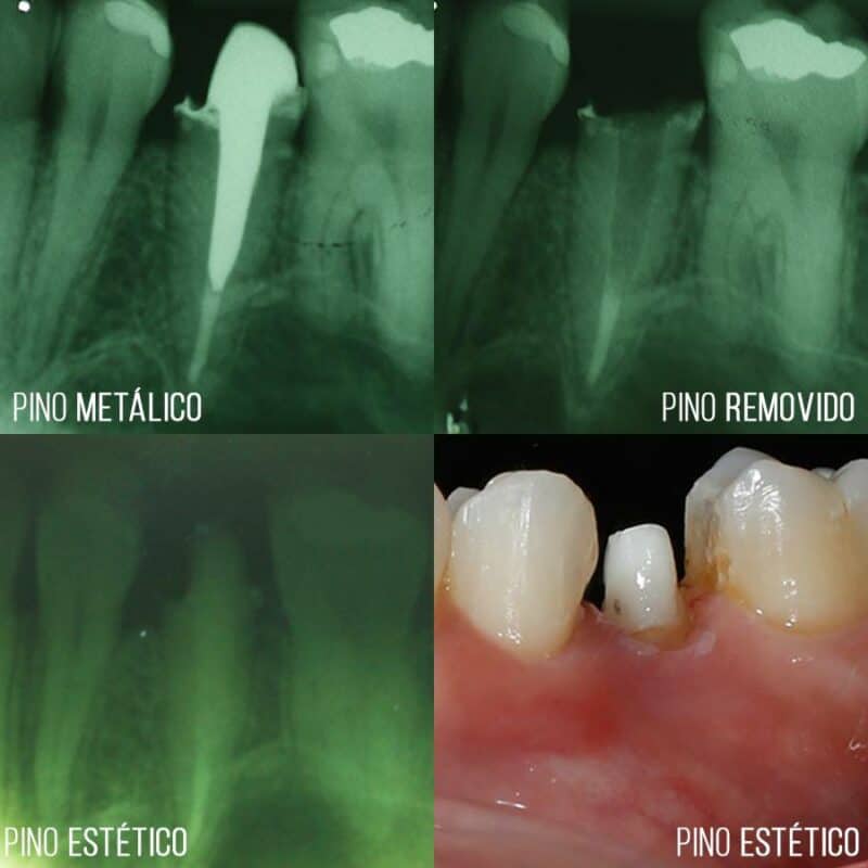 Para que serve um Pino Dentário