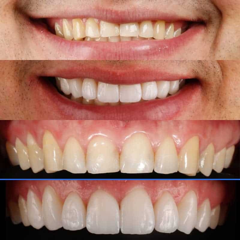 Lentes de contato dental antes e depois