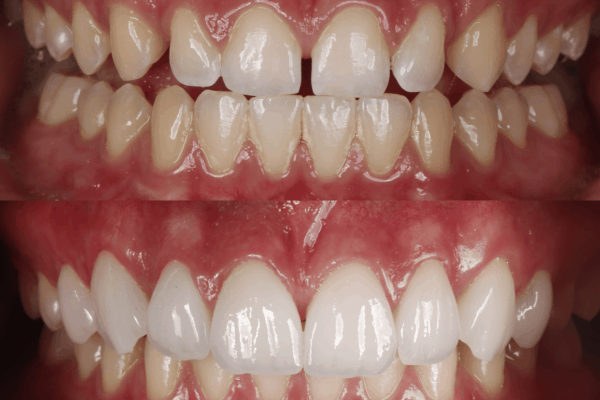 Lentes de Contato denta antes e depois