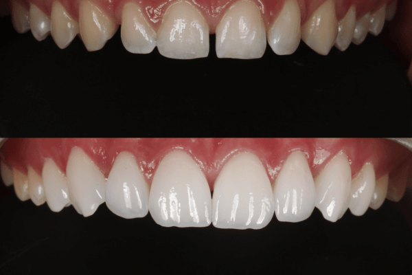 Lentes de contato dental antes e depois Fortaleza