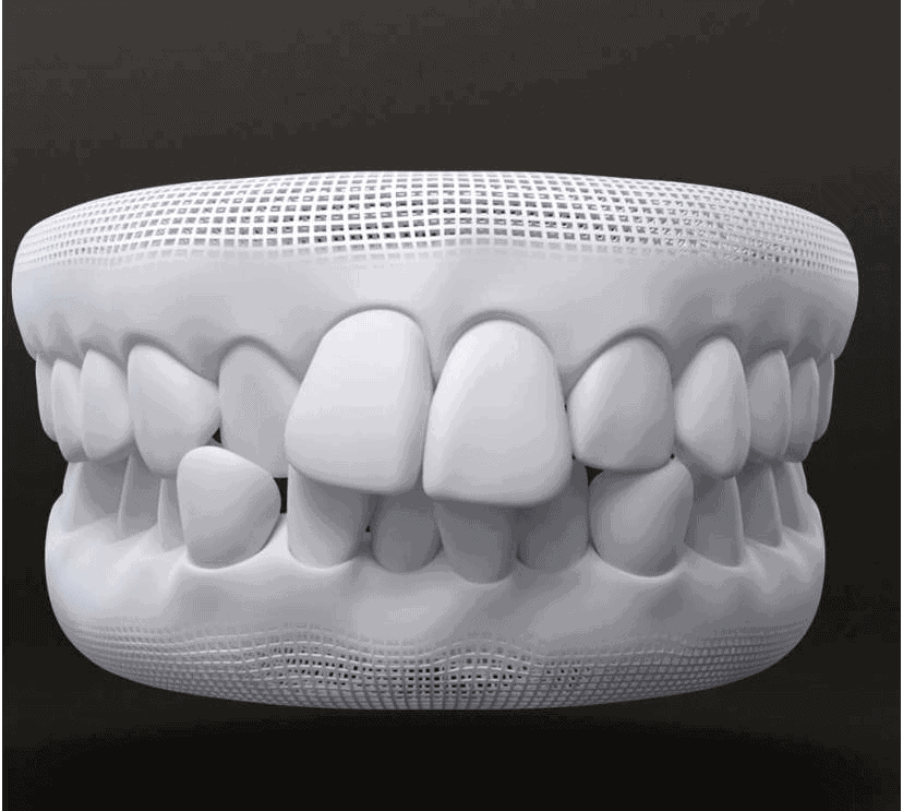 Tratamento para dentes apinhados com invisalign