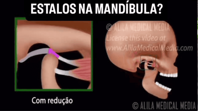 Estalos na mandíbula? Entenda o que pode ser