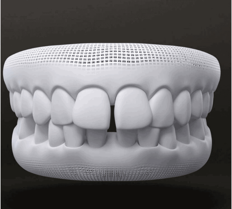Tratamento de diastema com invisalign
