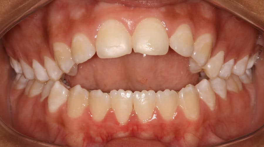 Mordida-aberta-na-infancia-causas-e-tratamentos