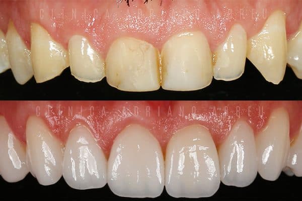 Antes e depois de tratamento de dentes desgastados com Lentes de Contato Dentais