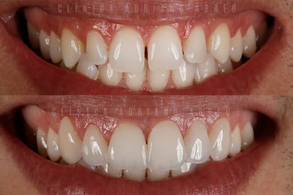 dentes-pequenos-aumento-com-lentes-de-contato-dentais-3