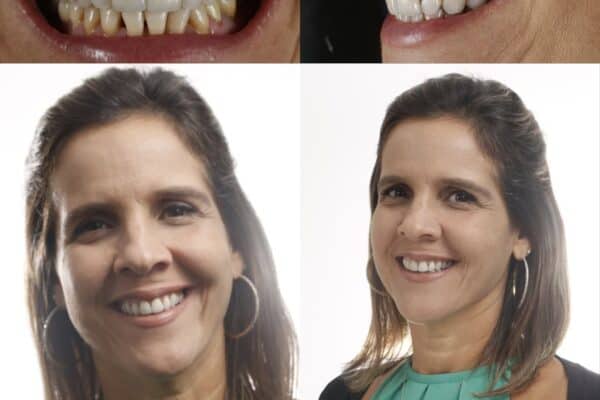 Tratamento para dimunuir os dentes -antes e depois